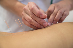 Acupuncture needles being put in body